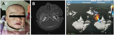 Case Report: Neuroblastoma Breakpoint Family Genes Associate With 1q21 Copy Number Variation Disorders